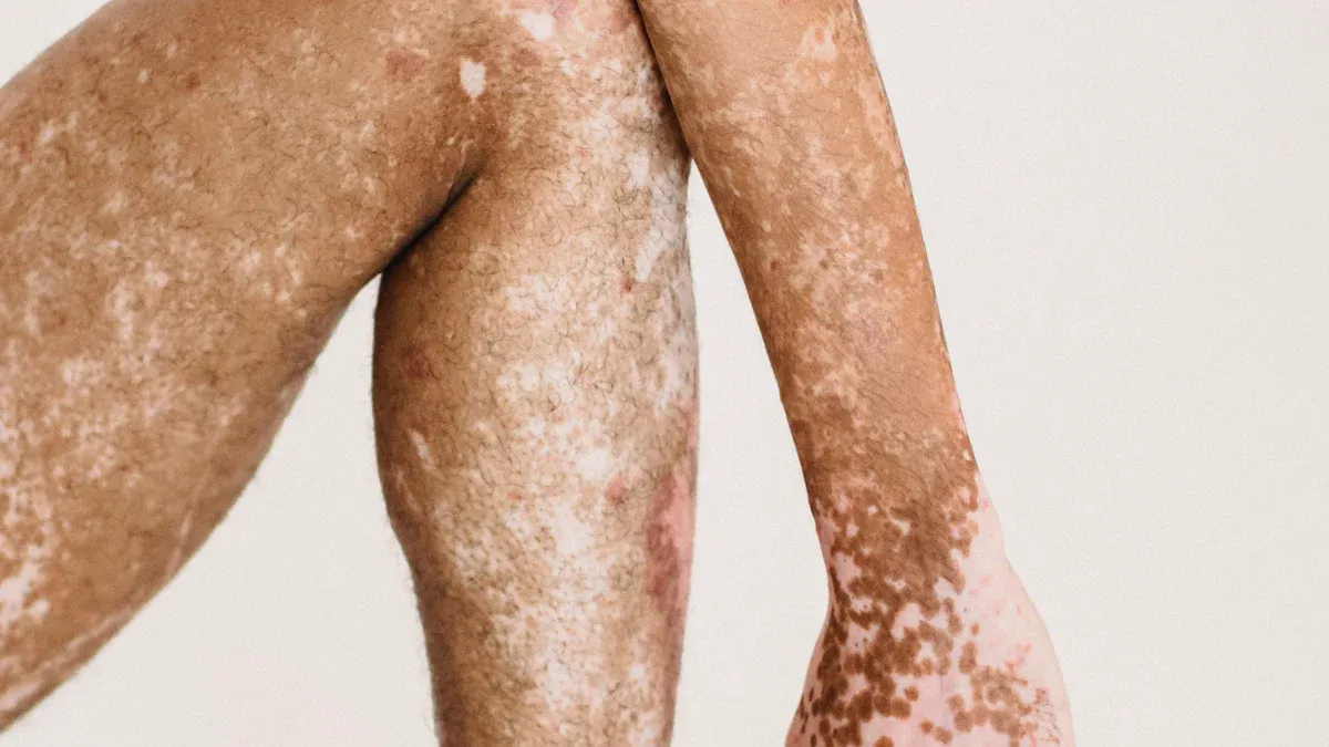 Celiac Disease Signs You Shouldn’t Ignore