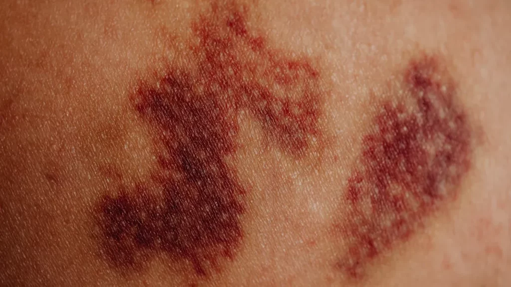 Cardiolipin Antibody: The Hidden Clotting Story Unveiled