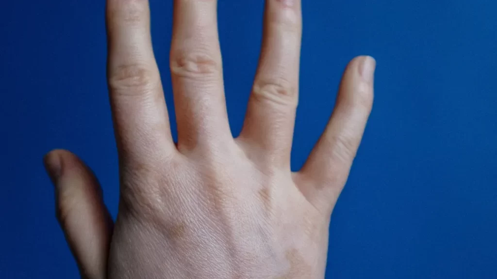 What Is Anticentromere Antibody and How Does It Help Diagnose Autoimmune Diseases