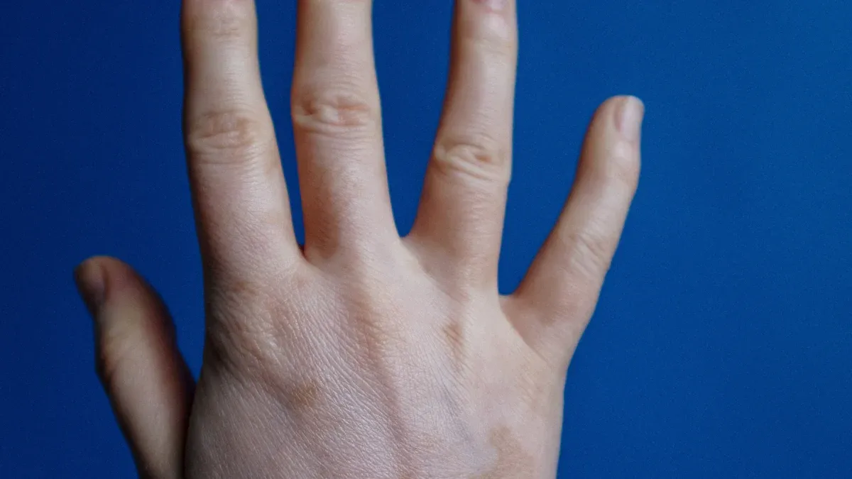What Is Anticentromere Antibody and How Does It Help Diagnose Autoimmune Diseases